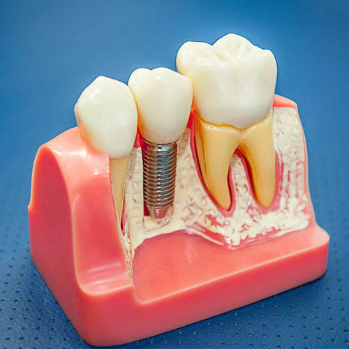 Dental Implant with Crown at Baker Ranch Dental Spa & Implant Center - Dentist in Lake Forest CA