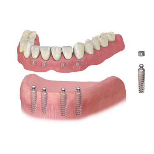 Implant Dentures at Baker Ranch Dental Spa & Implant Center - Dentist in Lake Forest CA