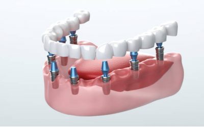 Dental implant in lake forest and foothill ranch California