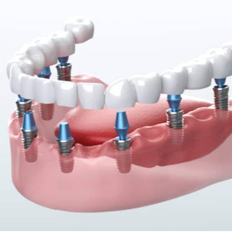 dental implant lake forest foothill ranch california