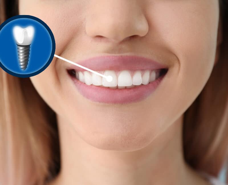 dental implants lake forest ca