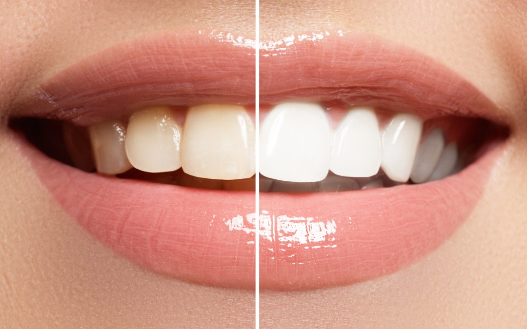 The Dos and Don’ts of At-Home Teeth Whitening: Expert Insights from Baker Ranch Dental in Lake Forest, CA