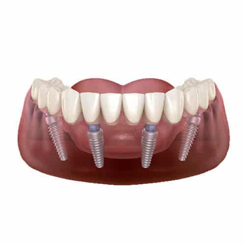 All on 4 Dental Implants at Baker Ranch Dental Spa & Implant Cen