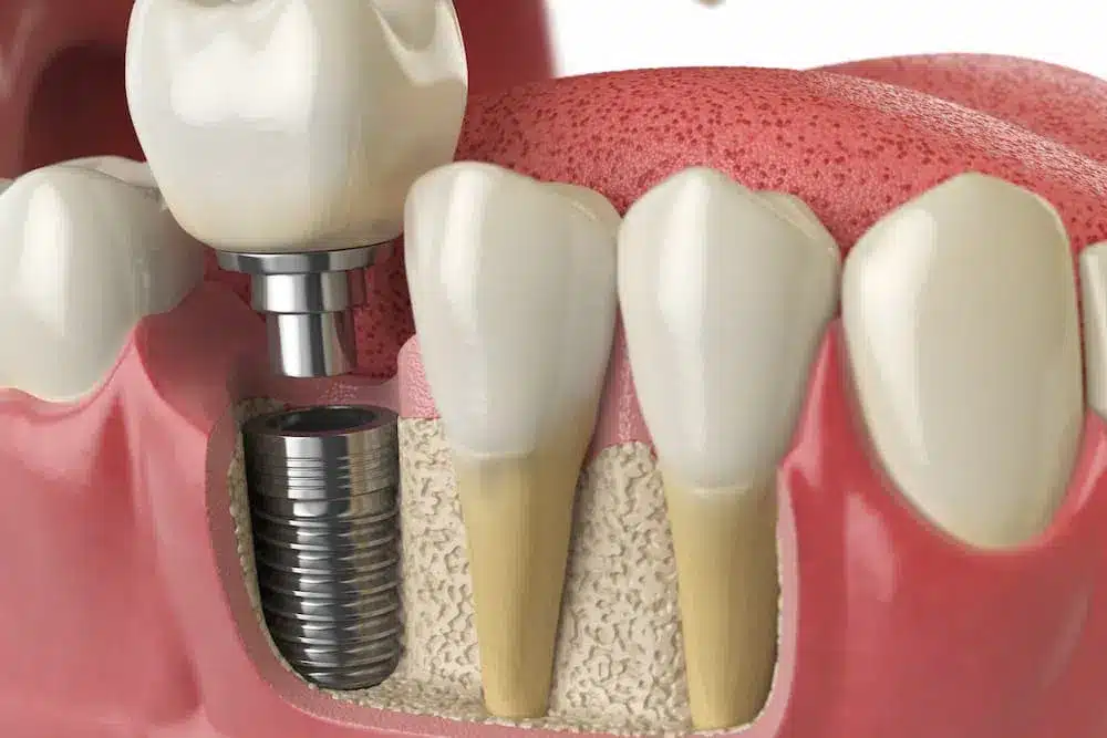 Dental implant illustration showing structure and placement.