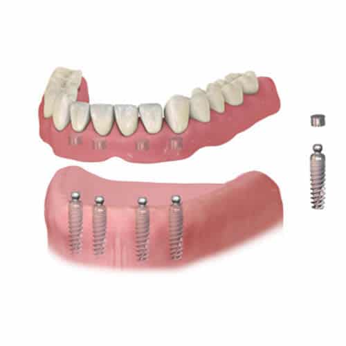 Implant Dentures at Baker Ranch Dental Spa & Implant Center De