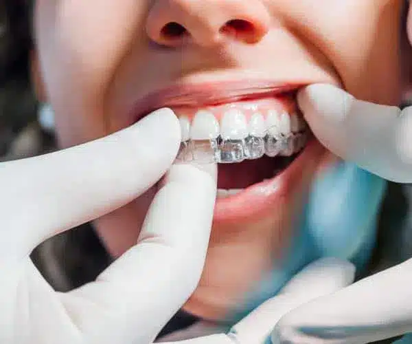 Invisalign in Baker ranch Dentistry and Implant Center Dentist in Lake Forest