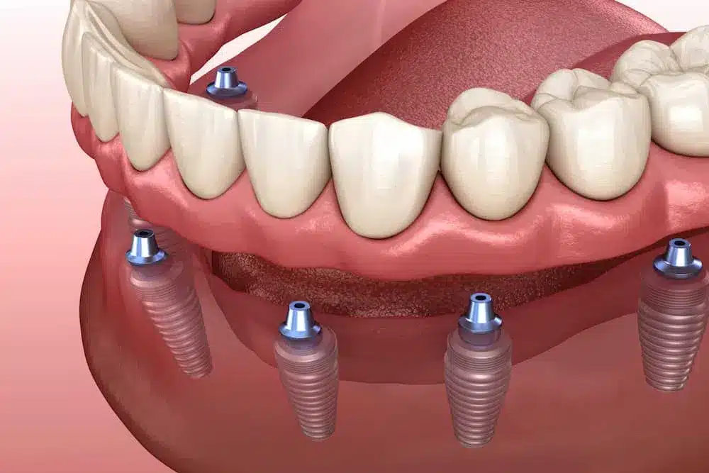 Illustration of dental implants supporting full denture